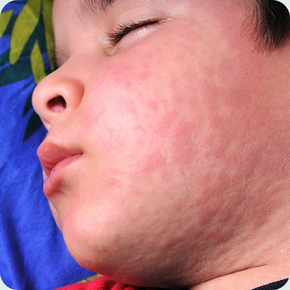 urticaria-in-children-paediatric-diagnostics